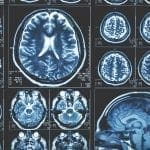 MRI Collection of brain scans: ID 113188023 © Ded Mityay | Dreamstime.com